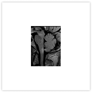 Рисунок 5. МРТ головного мозга пациента с ОНМ: очаг патологического накопления контрастного вещества в дорзаль ном отделе продолговатого мозга с распространением на area postrema